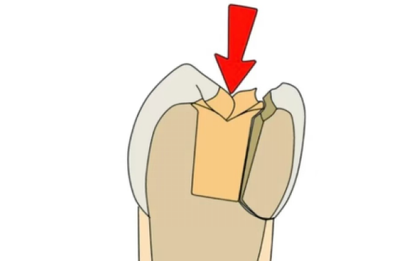 Common reasons for root canal treatment