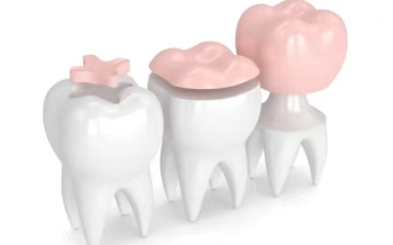 Steps of root canal treatment